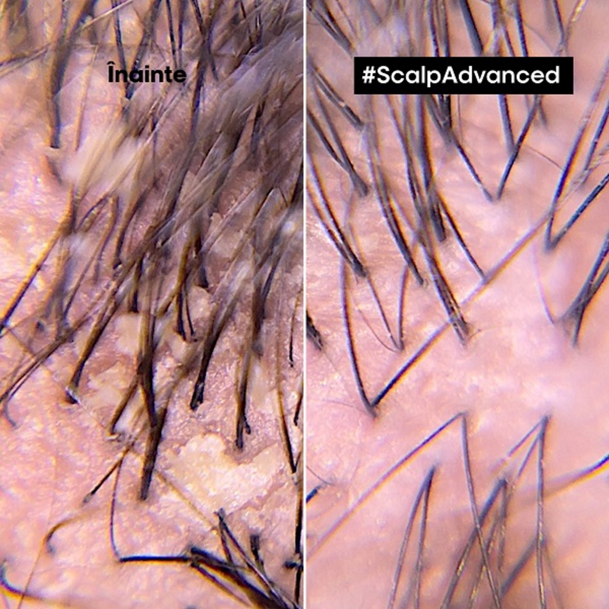 Sampon profesional anti matreata